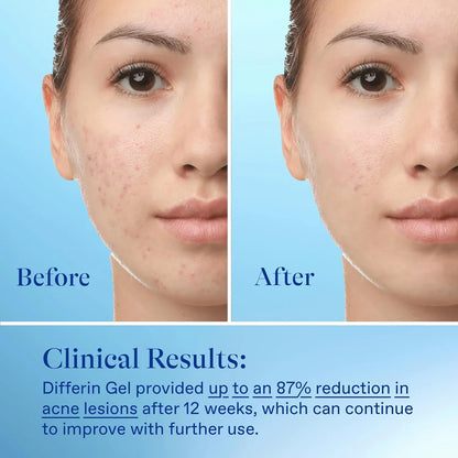 Differin Adapalene Gel 0.1% Acne Treatment 15g