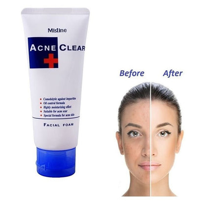 Mistine Acne Clear Facial Foam   85g